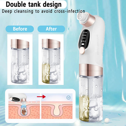 blackhead remover