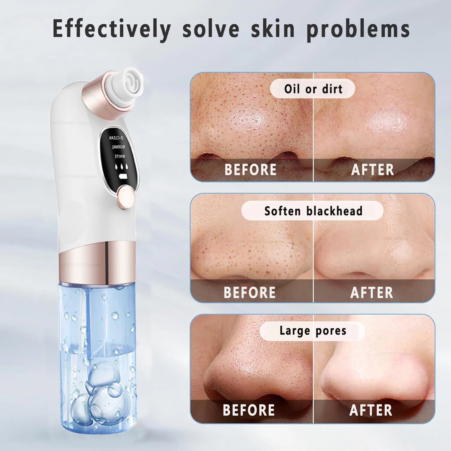 blackhead remover